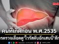 หมอ เตือน คนที่เกิดก่อน พ.ศ.2535 ควรตรวจเลือดดูไวรัสตับอักเสบบี สักครั้ง รู้เร็ว ลดเสี่ยงมะเร็งตับ
