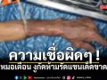 ความเชื่อผิดๆ ! หมอเตือน งูกัดห้ามลัดแขนเด็ดขาด เสี่ยงขาดเลือด