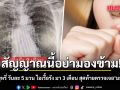 หมอเตือน ชายสูบบุหรี่ วันละ 5 มวน มีอาการไอเรื้อรัง มา 3 เดือน ซื้อยามากินเอง สุดท้ายตรวจเจอ มะเร็งปอด
