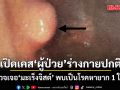 หมอมนูญ เปิดเคส ผู้ป่วย อายุ 60 ปี ร่างกายปกติ แต่ตรวจเจอ ‘มะเร็งจิสต์’ พบเป็นโรคหายาก 1 ในแสน