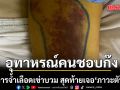 อุทาหรณ์คนชอบก๊ง! หมอสมองเล่าเคสคนไข้ มีอาการจ้ำเลือดเข่าบวม สุดท้ายเจอภาวะตับแข็ง