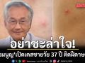 หมอมนูญ เปิดเคส ชายวัย 37 ปี ติดฝีดาษวานร เผยอาการเริ่มต้นและวิธีรักษา