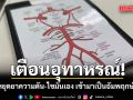 หมอยกเคส ลุง 58 เป็นความดัน-ไขมันสูง หยุดยาเอง เช้ามาเป็นอัมพฤกษ์ สโตรก ถามหาไม่ทันตั้งตัว