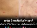 ระวัง!! มีเพศสัมพันธ์ต่างชาติ ชายไทยวัย 37 ติด \'ฝีดาษวานร\' หลังสัมพันธ์ผู้ติดเชื้อ HIV