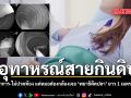 อุทาหรณ์สายกินดิบ สาวไร้อาการ-ไม่ปวดท้อง แต่หมอส่องกล้องเจอ \'พยาธิตืดปลา\' ยาว 1 เมตร คาลำไส้