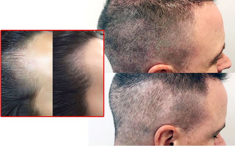 สักบนหนังศีรษะ ทางเลือกใหม่ของคนผมน้อย