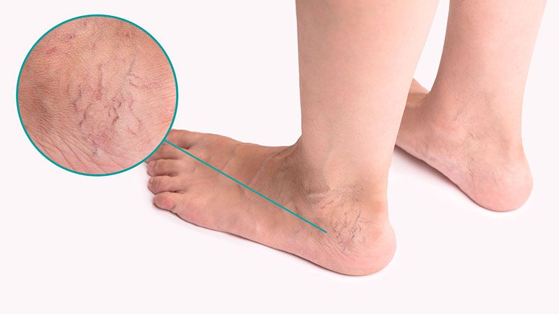 เส้นเลือดขอด ปัญหาใกล้ตัวที่หลายคนมองข้าม