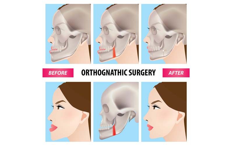 จบปัญหาการสบฟันผิดปกติ ด้วยวิธีผ่าตัดขากรรไกร