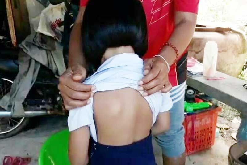 ฟาดแดงกลางหลัง 5ขวบโดนครูตีด้วยฝ่ามือ แม่แจ้งเอาผิด-รร.แจงแค่ปลายนิ้วสัมผัส