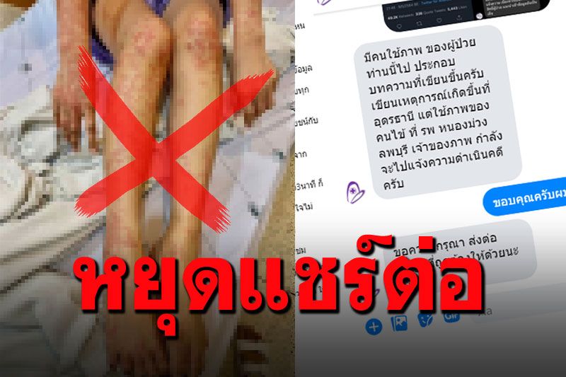 หยุดแชร์ต่อ! ภาพคนไข้ผิวเป็นรอยแดง โซเชียลแห่แชร์ว่าแพ้'วัคซีน'