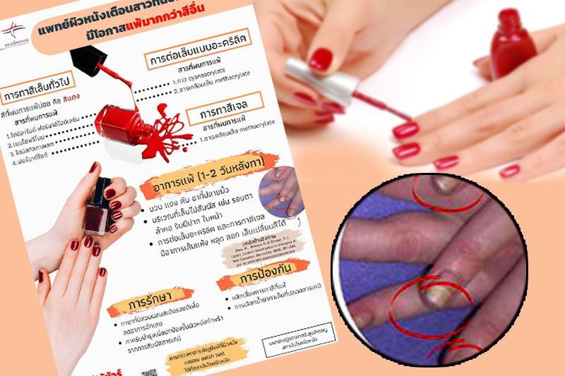แพทย์ผิวหนังเตือน! สาวๆนิยมทาเล็บสีแดง มีโอกาสแพ้มากกว่าสีอื่น