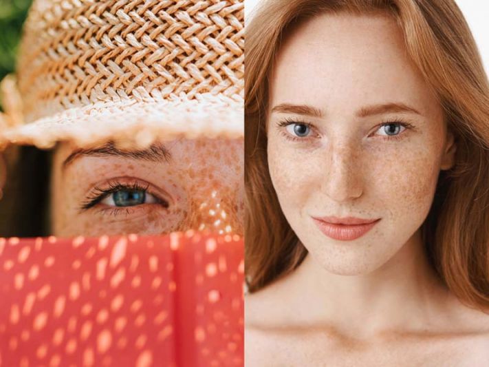 บอกลา ‘ฝ้า’ ด้วย ‘โปรไบโอติก’  นักวิจัยชี้ ‘โภชนเภสัช’ตัวช่วยใหม่ในการลดฝ้า