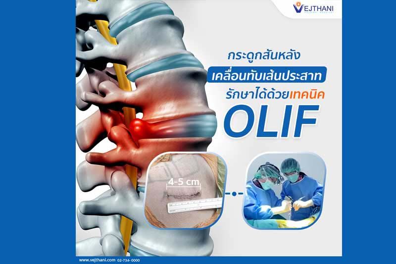 กระดูกสันหลังเคลื่อนทับเส้นประสาท รักษาได้ด้วยเทคนิค OLIF