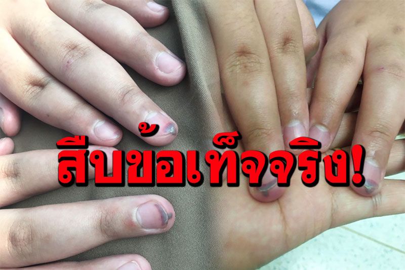 สพป.เขต 2 จี้โรงเรียนเร่งสืบข้อเท็จจริงครูทำโทษ ป.6 นิ้วห้อเลือด พบประวัติเคยตบหน้า นร.