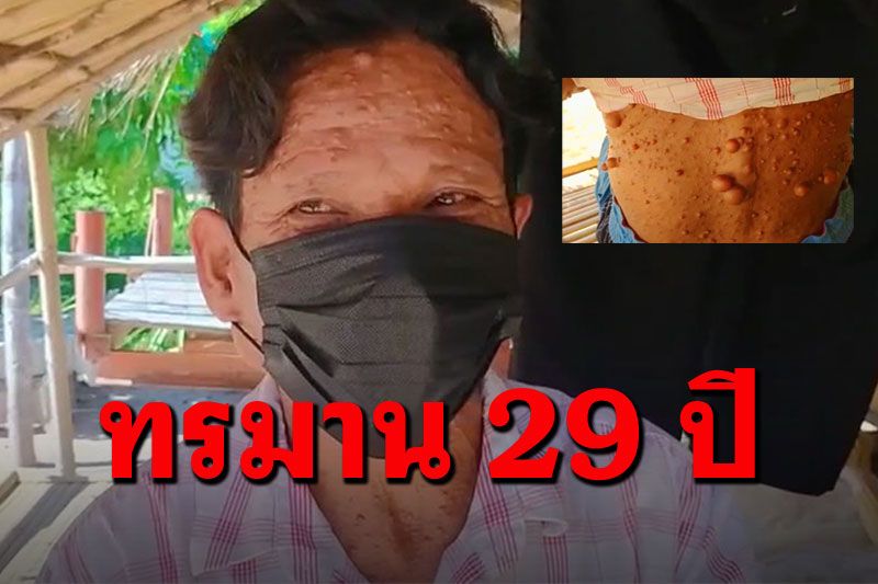 คุณลุงวัย50ป่วยท้าวแสนปม ไร้เงินรักษา-อาศัยกระท่อมหญ้าคาหลับนอน