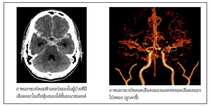 ภาวะเลือดออกในเยื่อหุ้มสมองใต้ชั้นอะแรชนอยด์ เนื่องจากหลอดเลือดสมองโป่งพองแตก