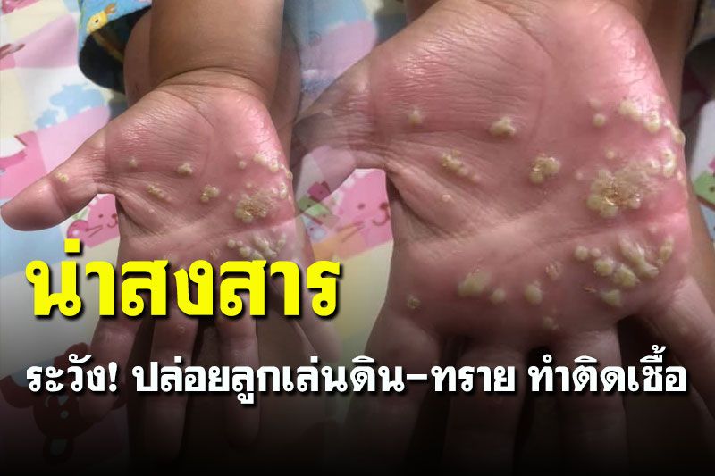 ลูกเอ้ย...น่าสงสาร! เตือนอย่าปล่อยลูกเล่น 'ดิน-ทราย' ทำติดเชื้อตุ่มหนองเต็มมือ
