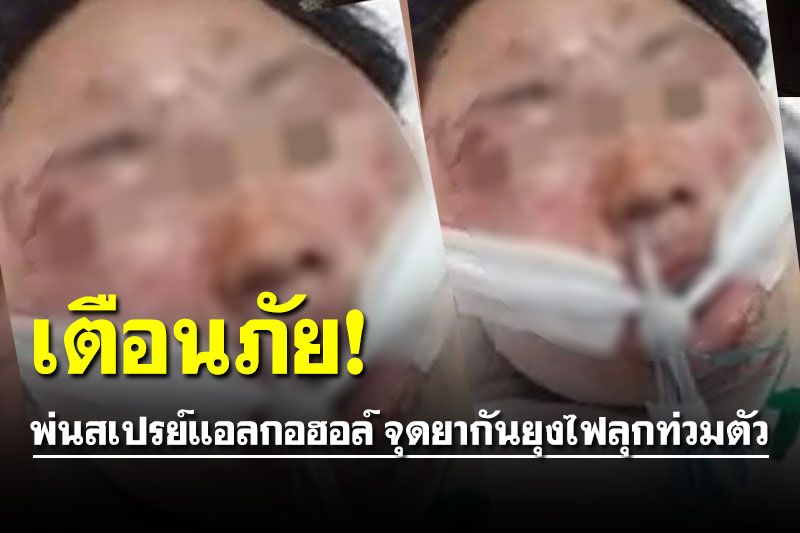 ภัยใกล้ตัว! สาวพ่นสเปรย์แอลกอฮอล์ก่อนเข้าบ้าน จุดยากันยุงไฟลุกท่วมตัว