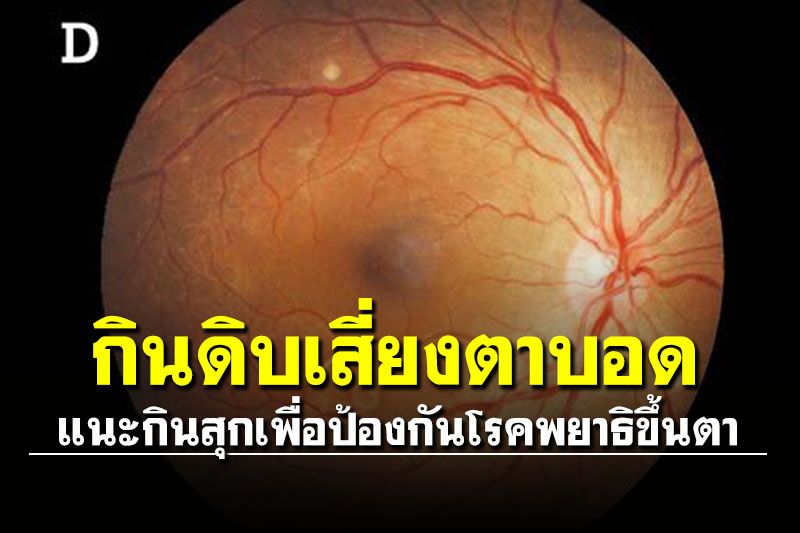 แพทย์ มข.เผยกินดิบเสี่ยงตาบอด แนะกินสุกเพื่อป้องกันโรคพยาธิขึ้นตา