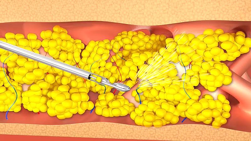 ศัลยกรรมเสริมหน้าอกผู้ป่วยมะเร็งเต้านมด้วยเทคนิค ‘Fat Stem Cell’