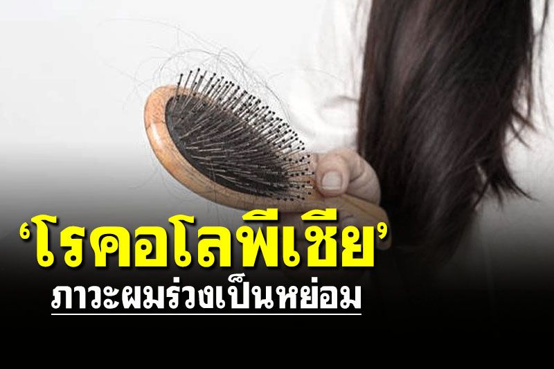 มาทำความรู้จัก! 'โรคอโลพีเชีย' ภาวะผมร่วงเป็นหย่อม