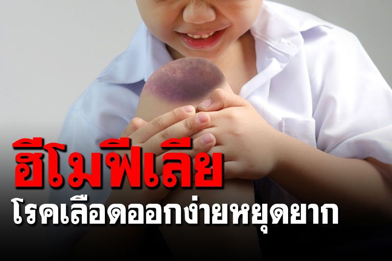 ฮีโมฟีเลีย-โรคเลือดออกง่ายหยุดยาก  รักษาแบบป้องกันเพื่อคุณภาพชีวิตที่ดีขึ้นของผู้ป่วย