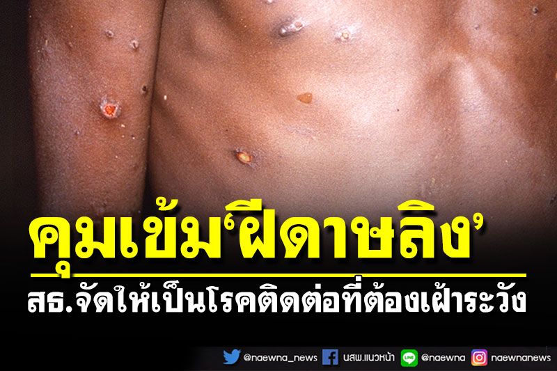 สธ.จัดให้'ฝีดาษลิง'เป็นโรคติดต่อที่ต้องเฝ้าระวัง แต่ยังไม่มีผู้ป่วยในไทย