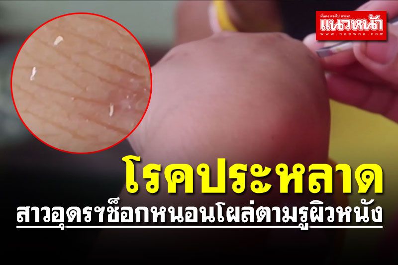 สาวอุดรฯช็อกตัวประหลาดคล้ายหนอนโผล่ตามรูผิวหนัง คนในบ้านติด 4 ราย
