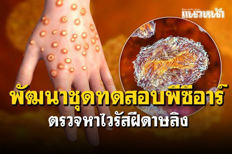โรชเผยการพัฒนาชุดทดสอบพีซีอาร์เพื่อตรวจหาไวรัสฝีดาษลิง