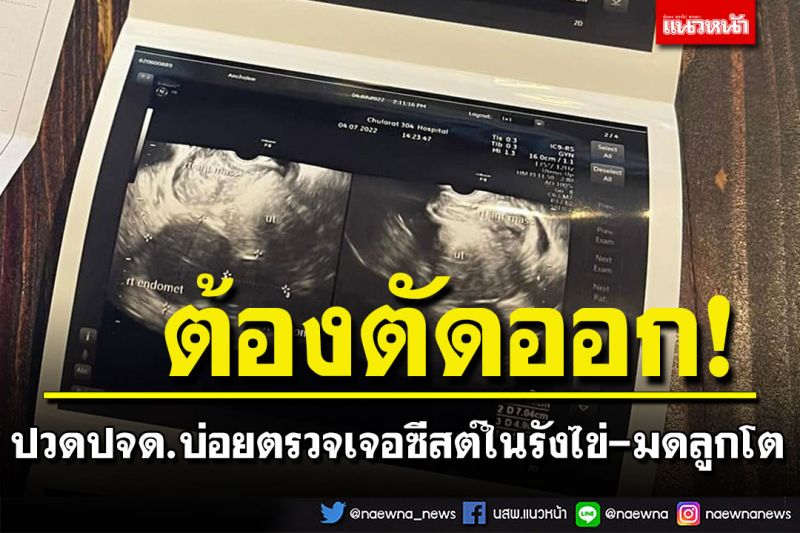 สาวปวดท้องประจำเดือนบ่อย พบแพทย์ตรวจเจอซีสต์ในรังไข่-มดลูกโต 15 ซม. ต้องตัดออก