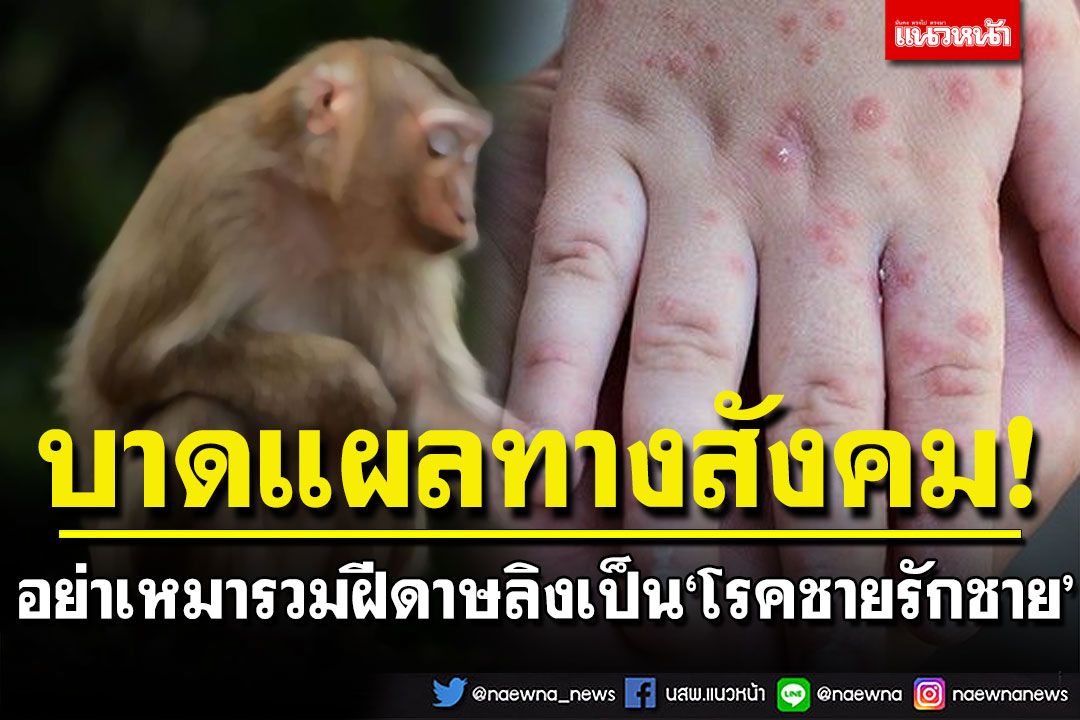 ศูนย์จีโนมฯเผยอย่าเหมารวมฝีดาษลิง เป็น‘โรคชายรักชาย’ ซึ่งไม่เป็นผลดีต่อการควบคุมโรค