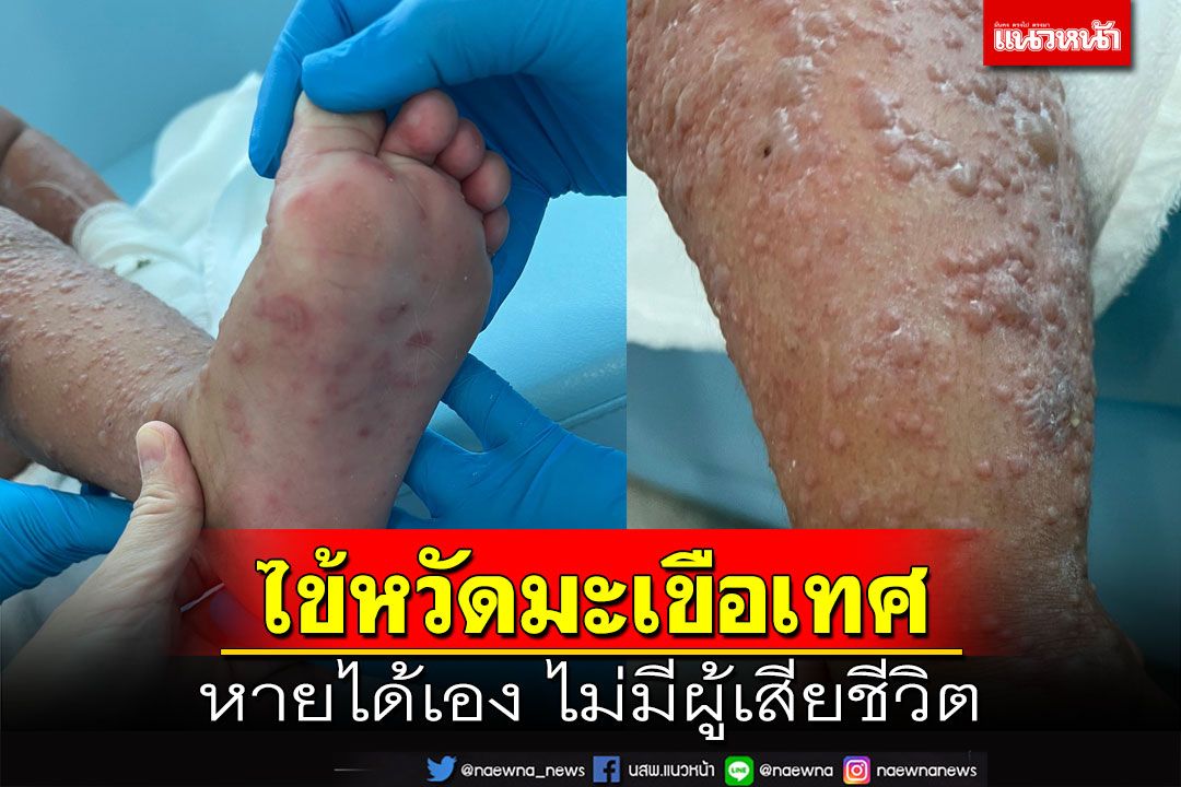 ‘หมอยง’เลคเชอร์‘ไข้หวัดมะเขือเทศ’ ย้ำไม่รุนแรง หายได้เอง ไม่มีผู้เสียชีวิต