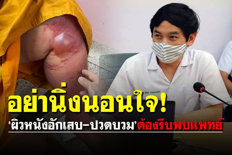 อย่านิ่งนอนใจ! ‘ผิวหนังอักเสบ-ปวดบวม’ขยายเป็นไฟลามทุ่ง ต้องรีบพบแพทย์
