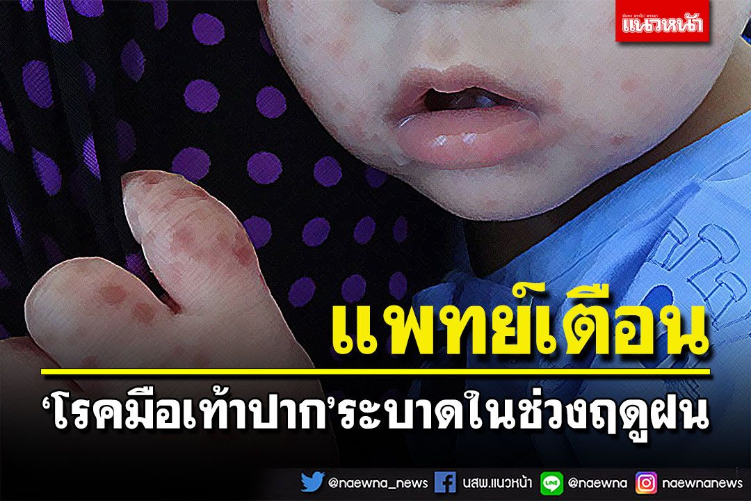 แพทย์เตือน ‘โรคมือเท้าปาก’ ระบาดในช่วงฤดูฝน