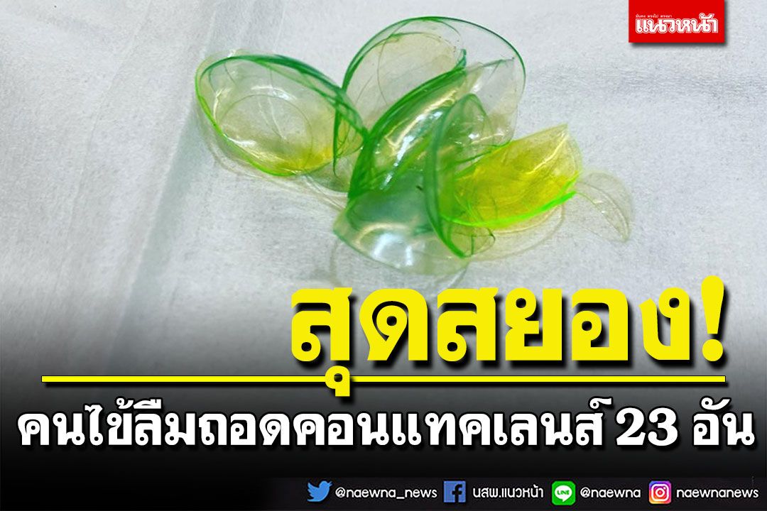 ผงะ! คนไข้ลืมถอดคอนแทคเลนส์ 23 อัน หมอช่วยเขี่ยออก อุทาหรณ์คนขี้ลืม