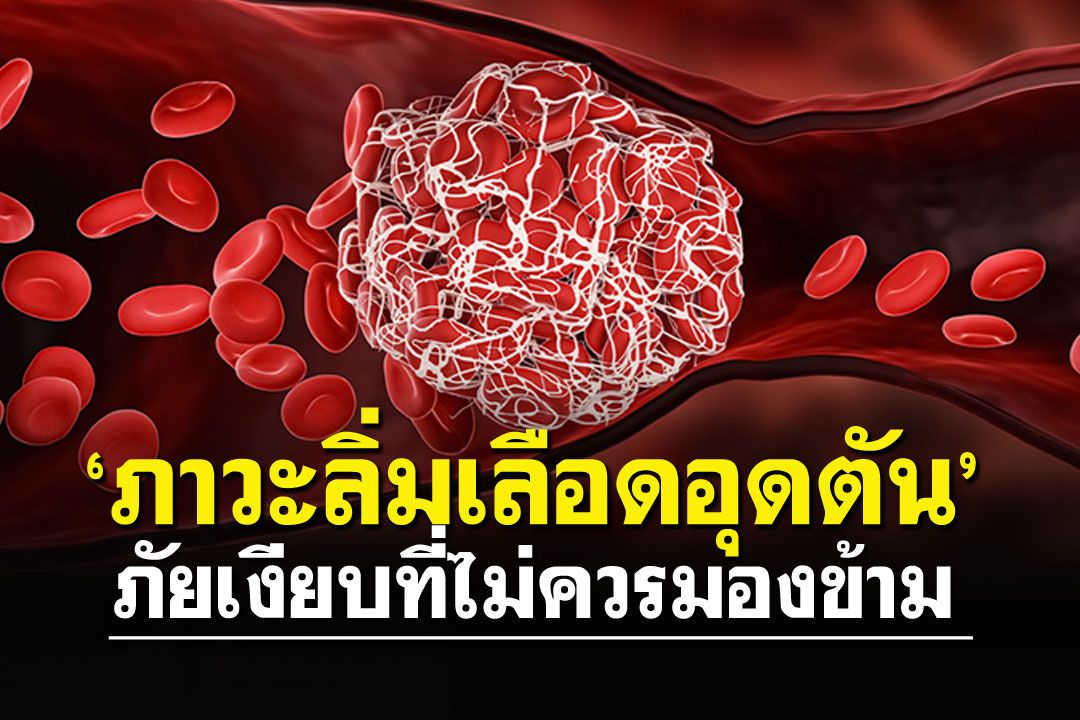‘ภาวะลิ่มเลือดอุดตัน’ภัยเงียบที่ไม่ควรมองข้าม  รู้เร็ว ป้องกันได้ลดการตายเฉียบพลับ