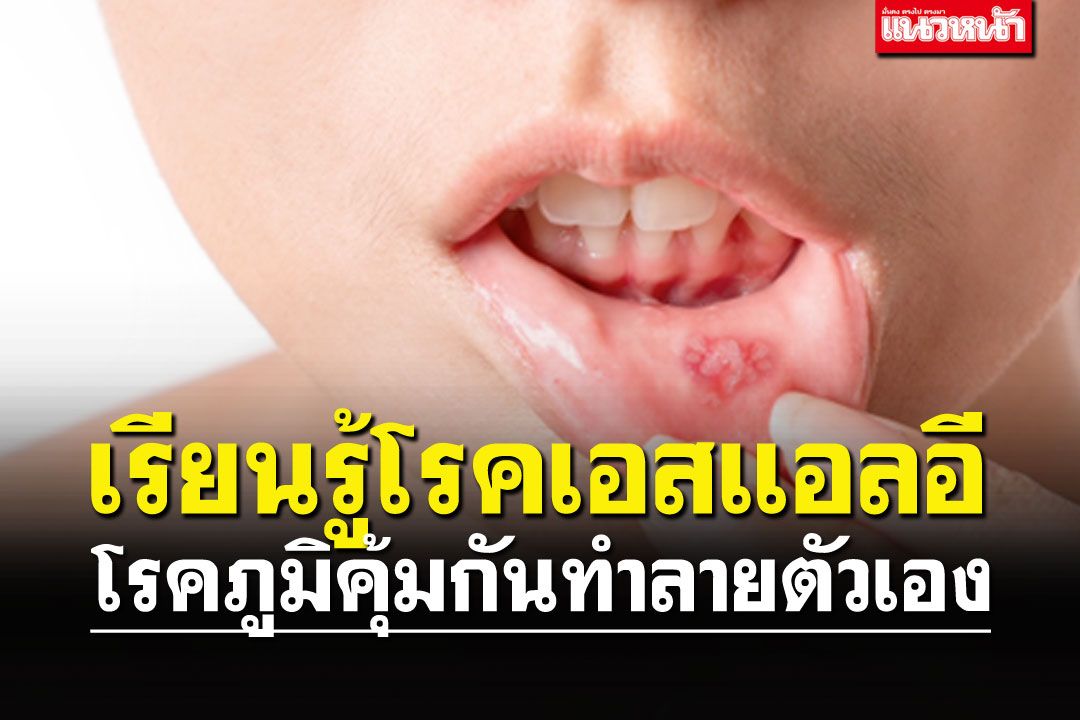 LIFE & HEALTH : เรียนรู้โรคเอสแอลอี…โรคภูมิคุ้มกันทำลายตัวเอง