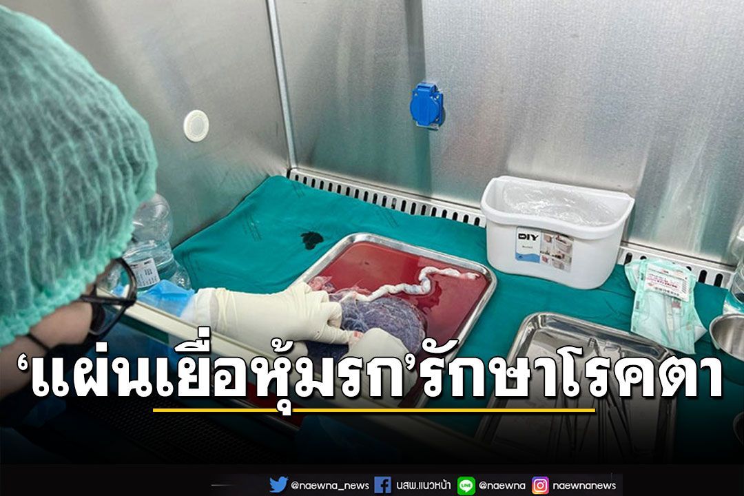 ม.วลัยลักษณ์ผลิต ‘แผ่นเยื่อหุ้มรก’  รักษาโรคตา ครั้งแรกของภาคใต้ตอนบน