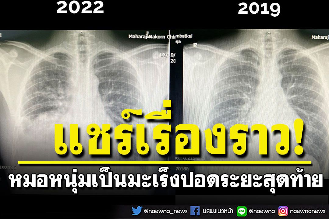 หมอหนุ่มวัย 28 เผยเรื่องราว เป็นมะเร็งปอดระยะสุดท้าย ทั้งที่แข็งแรง-ดูแลสุขภาพอย่างดี