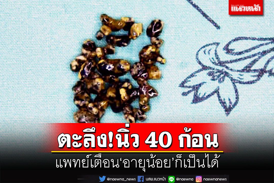 ตะลึง!พบนิ่วในถุงน้ำดีผู้ป่วยกว่า 40 ก้อน แพทย์เตือนอายุน้อยก็เป็นได้