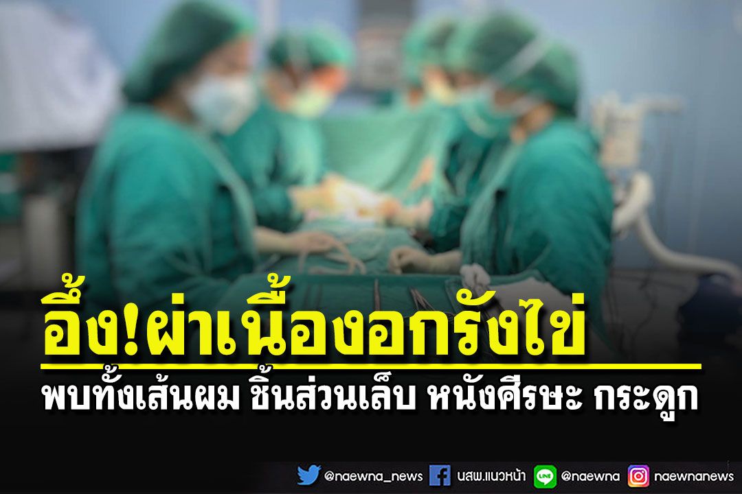 อึ้ง!!! พบเส้นผม หนังศีรษะ เล็บ ฟัน กระดูก ไขมัน ในก้อนเนื้องอกรังไข่