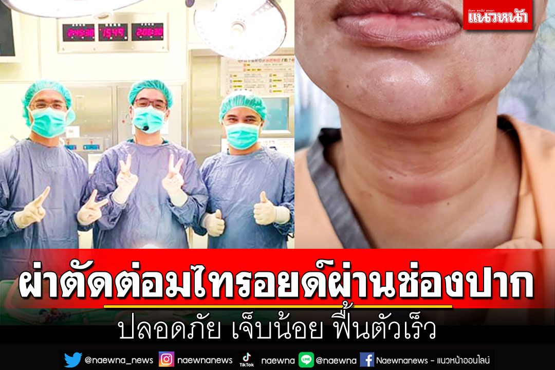 ผ่าตัดต่อมไทรอยด์ผ่านทางช่องปาก  ปลอดภัย เจ็บน้อย ฟื้นตัวเร็ว