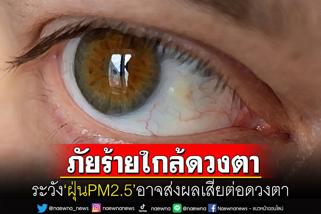 เตือนระวังฝุ่นพิษPM 2.5ส่งผลเสียต่อดวงตา หากมีการระคายเคืองพบแพทย์ด่วน