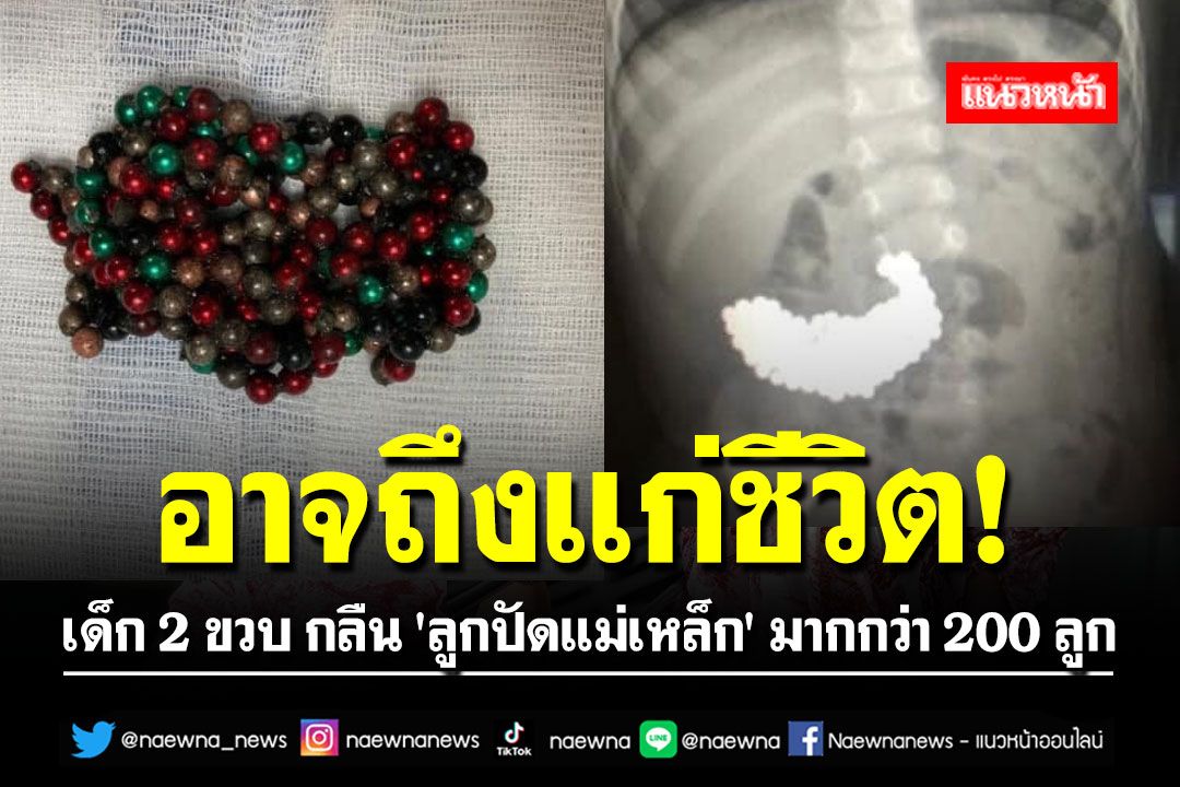 อาจถึงแก่ชีวิต! เด็ก 2 ขวบ กลืน 'ลูกปัดแม่เหล็ก' มากกว่า 200 ลูก