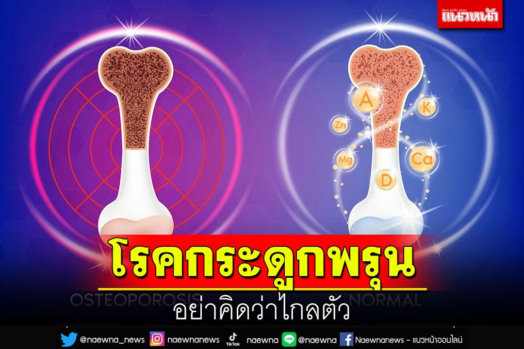 โรคกระดูกพรุน อย่าคิดว่าไกลตัว