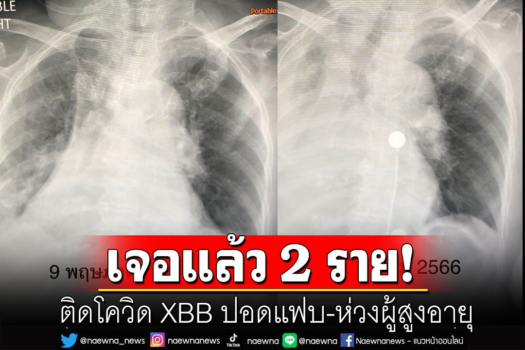 'หมอมนูญ'ห่วงผู้สูงอายุ ติดโควิด XBB เสี่ยงดับ เจอปอดแฟบแล้ว 2 คน