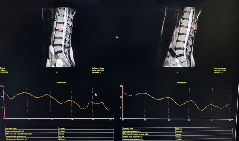 เทคโนโลยีใหม่ วิเคราะห์ผลตรวจการทำ MRI แบบยืน  วินิจฉัยโรคเกี่ยวกับกระดูกสันหลัง แม่นยำและตรงจุด