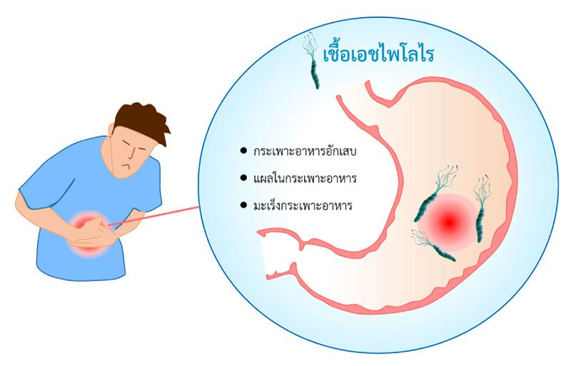 เฮลิโคแบคเตอร์ ไพโลไร ภัยร้ายในกระเพาะอาหาร