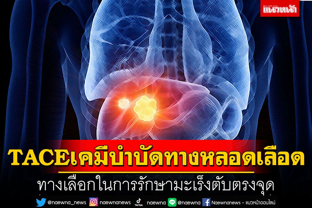 TACE เคมีบำบัดทางหลอดเลือด ทางเลือกในการรักษามะเร็งตับตรงจุด