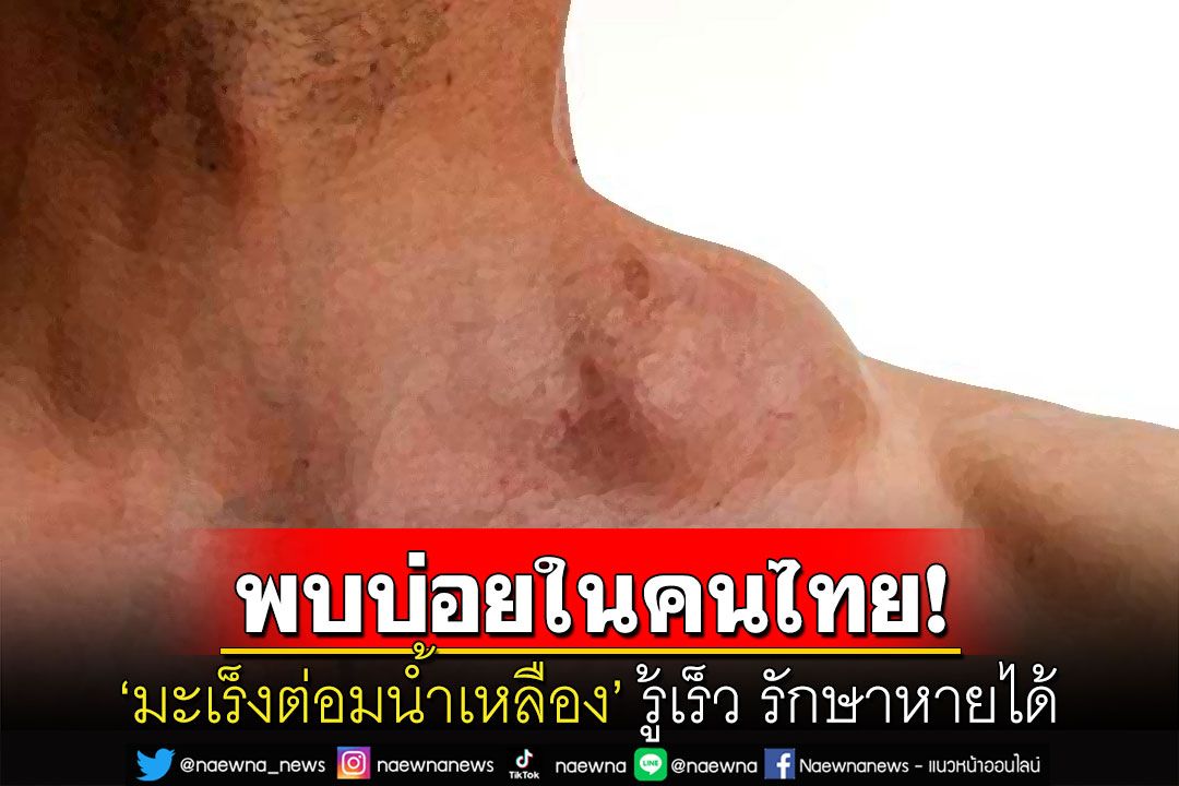 พบบ่อยในคนไทย! 'มะเร็งต่อมน้ำเหลือง'ใกล้ตัวกว่าที่คิด แพทย์แนะหมั่นคลำสำรวจตัวเอง